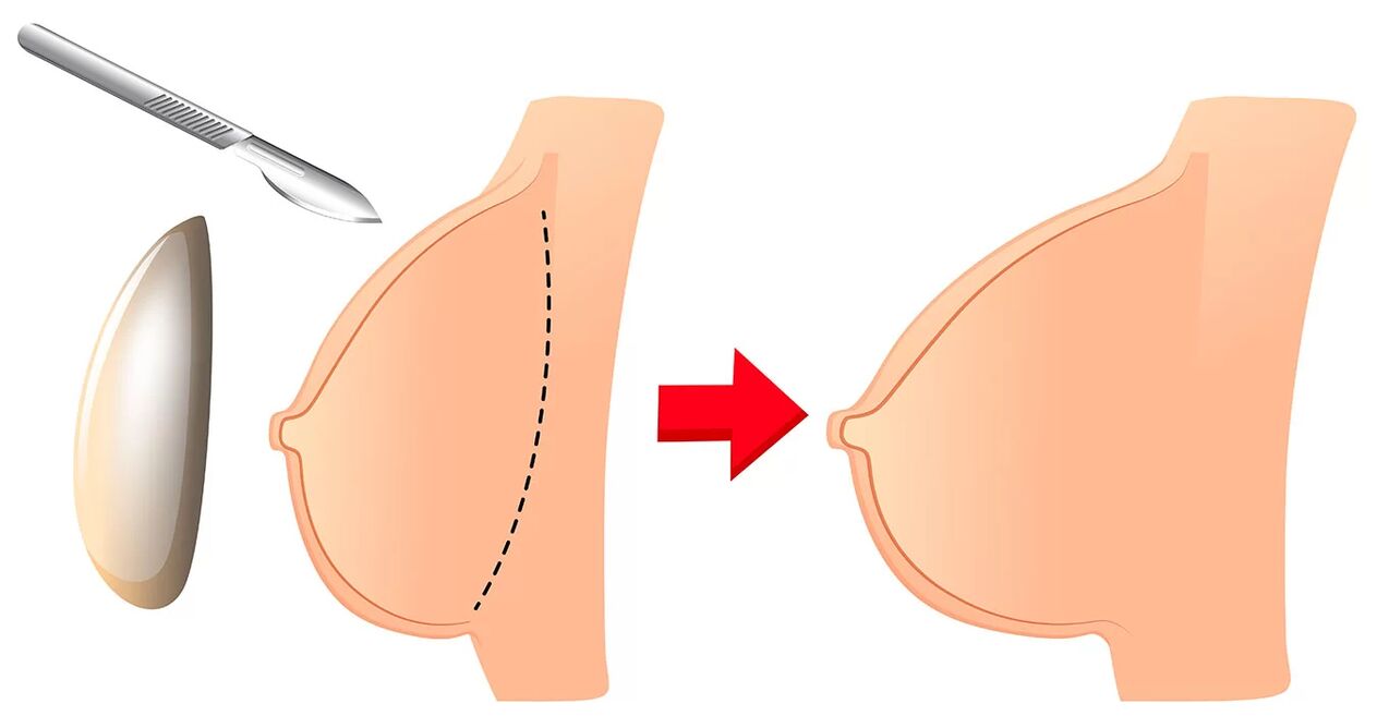 Aumento del seno con una protesi